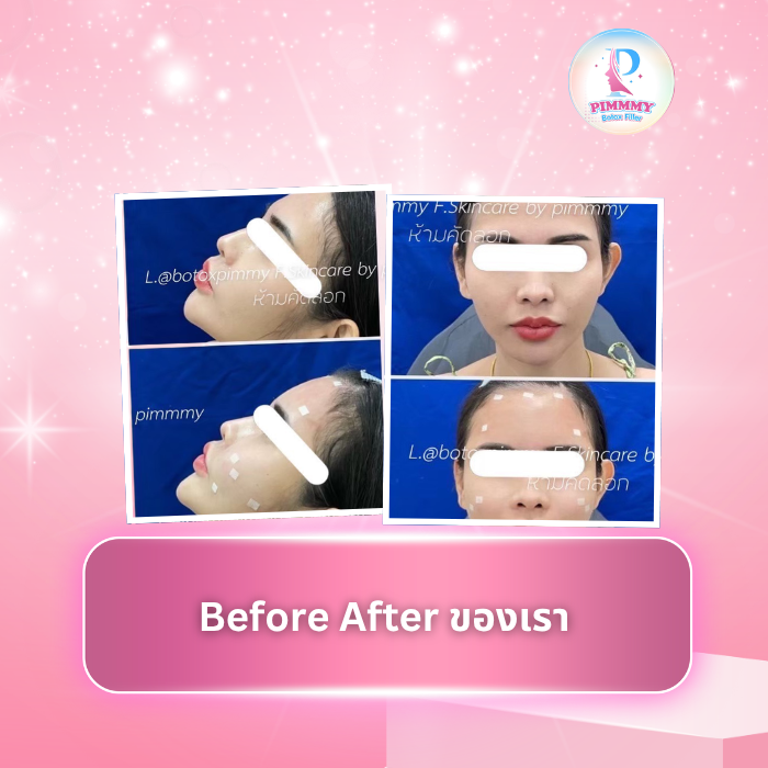 Before After ของเรา